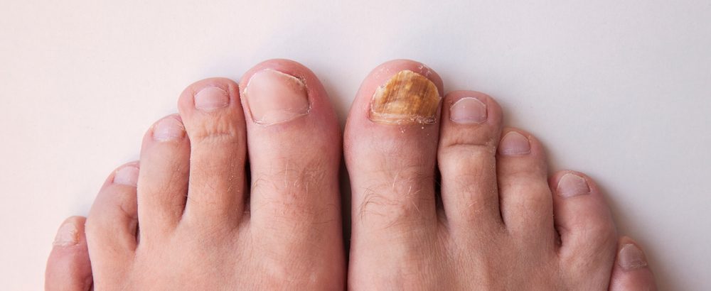 How to treat a fungal nail infection | Health | The Guardian